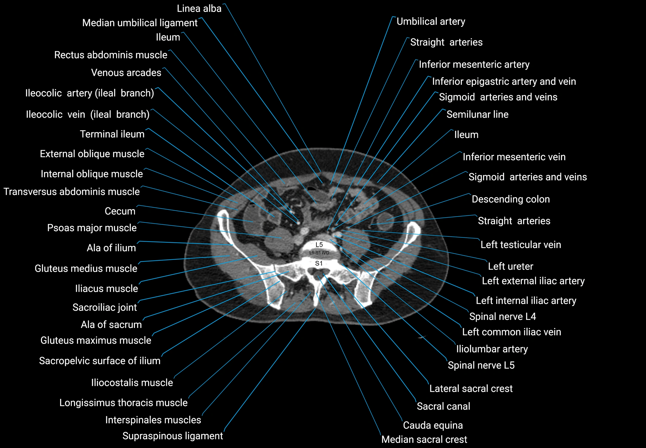 CT male pelvis axial cross sectional anatomy labelled radiology image -00135.webp